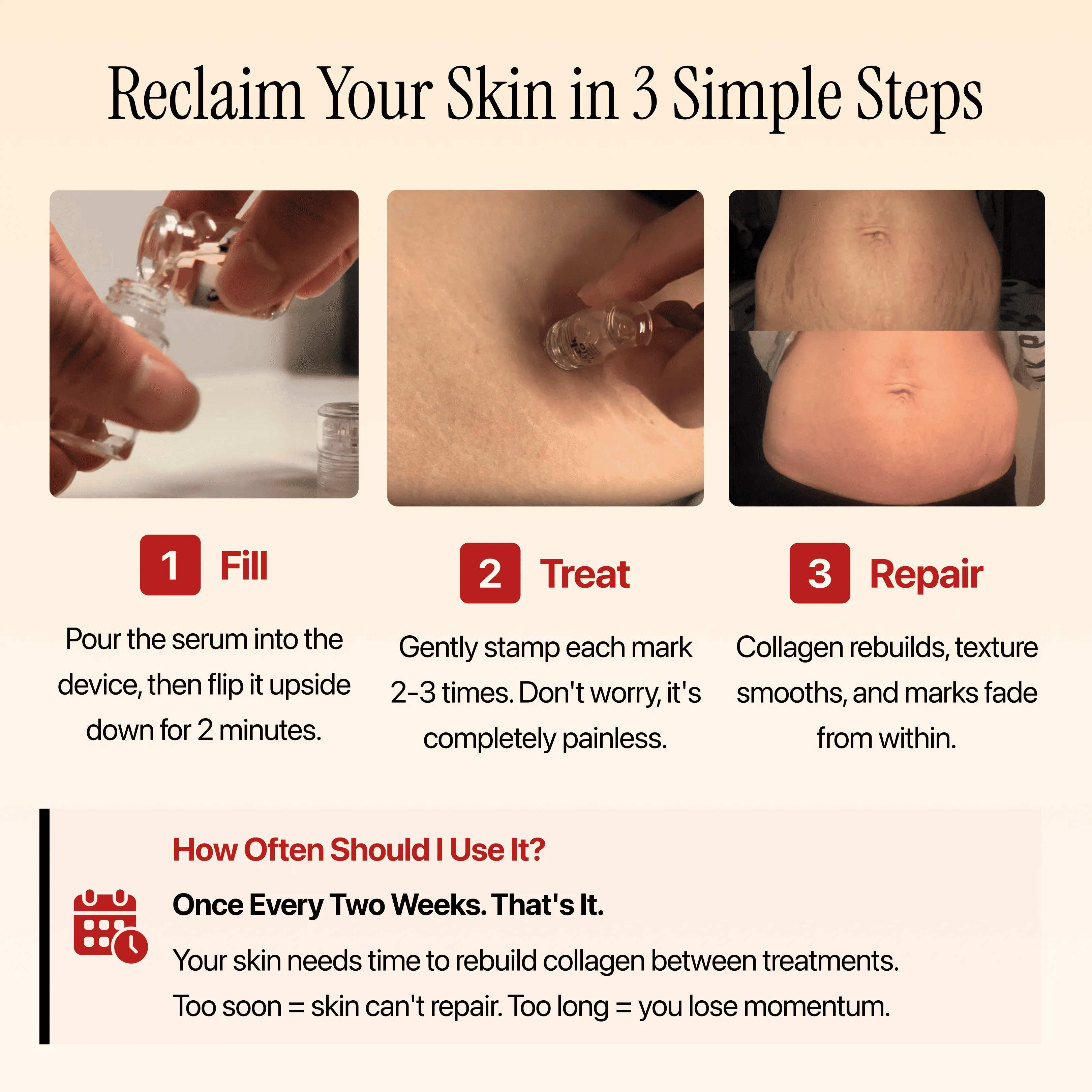 SeekGlo Stretch Mark System