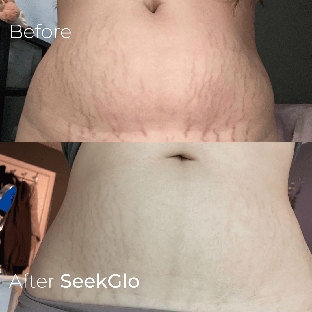 SeekGlo Stretch Mark System