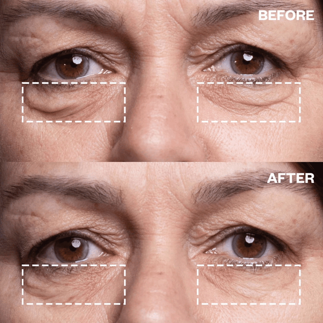 SeekGlo Microneedle Eye Patches