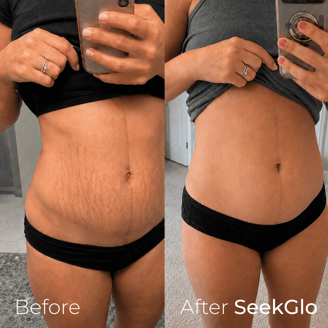 SeekGlo Stretch Mark System