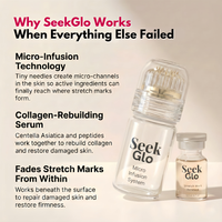 SeekGlo Stretch Mark System