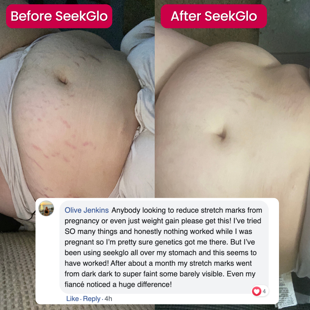 SeekGlo Stretch Mark System