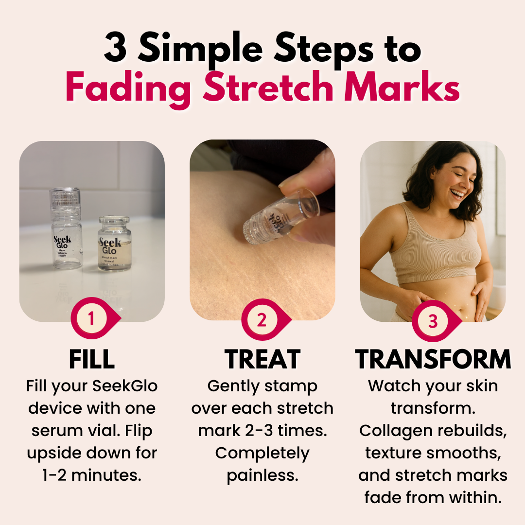 SeekGlo Stretch Mark System