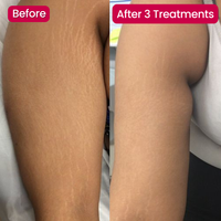 SeekGlo Stretch Mark System