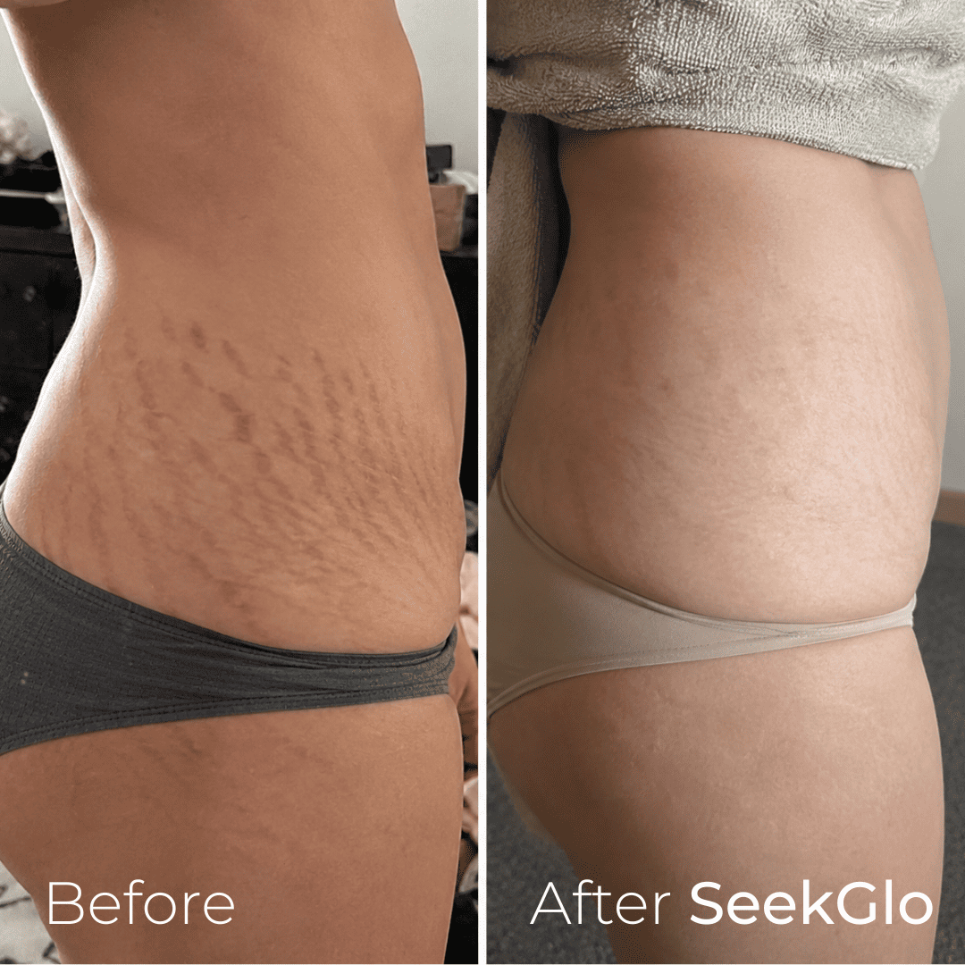 SeekGlo Stretch Mark System