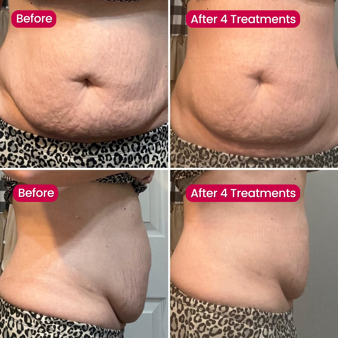 SeekGlo Stretch Mark System