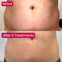 SeekGlo Stretch Mark System