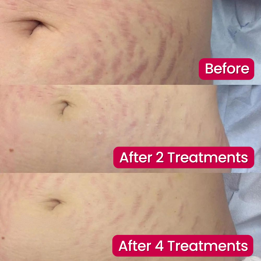 SeekGlo Stretch Mark System
