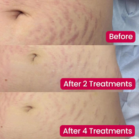 SeekGlo Stretch Mark System