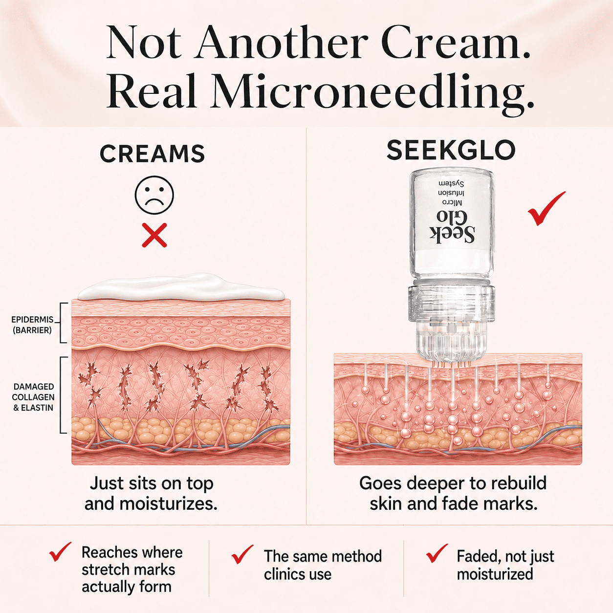 SeekGlo Stretch Mark System