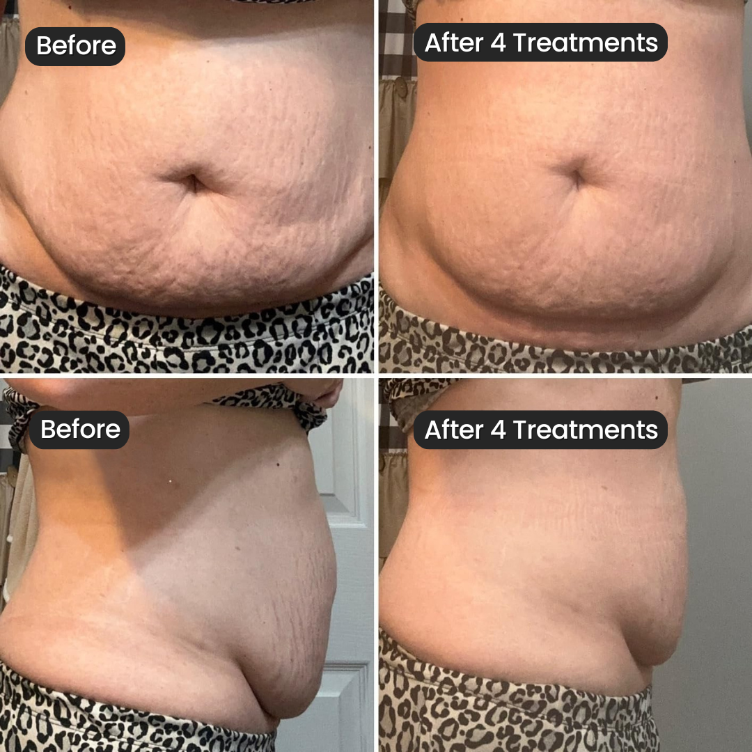SeekGlo Stretch Mark System