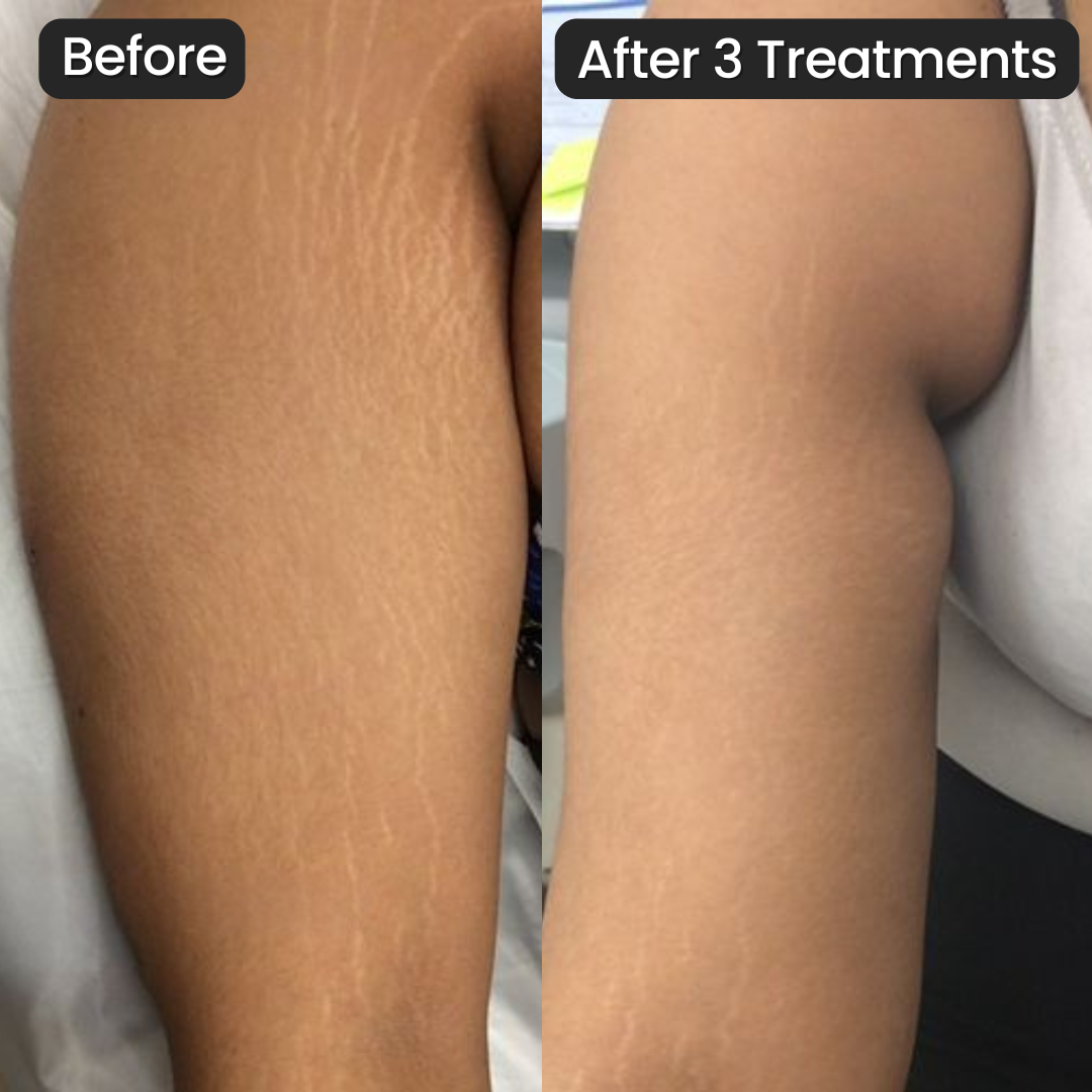 SeekGlo Stretch Mark System